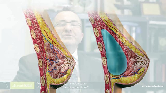 İzsiz göğüs büyütme ameliyatları doğum ve emzirmeye engel midir? Dr. Nuri Battal