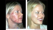 Acne No More - Natural anti-acne treatments!
