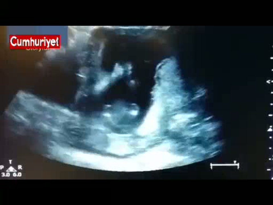 Ultrasonda ilginç anlar: Anne şarkı söyle, bebek alkış tuttu