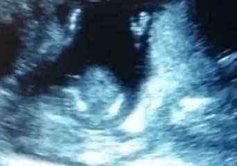 Ultrasound Baby Claps Along With Mother's Song
