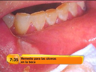 Remedios para las úlceras en su boca