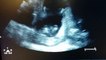 Ultrasound Shows Unborn Baby Clapping Hands In The Womb