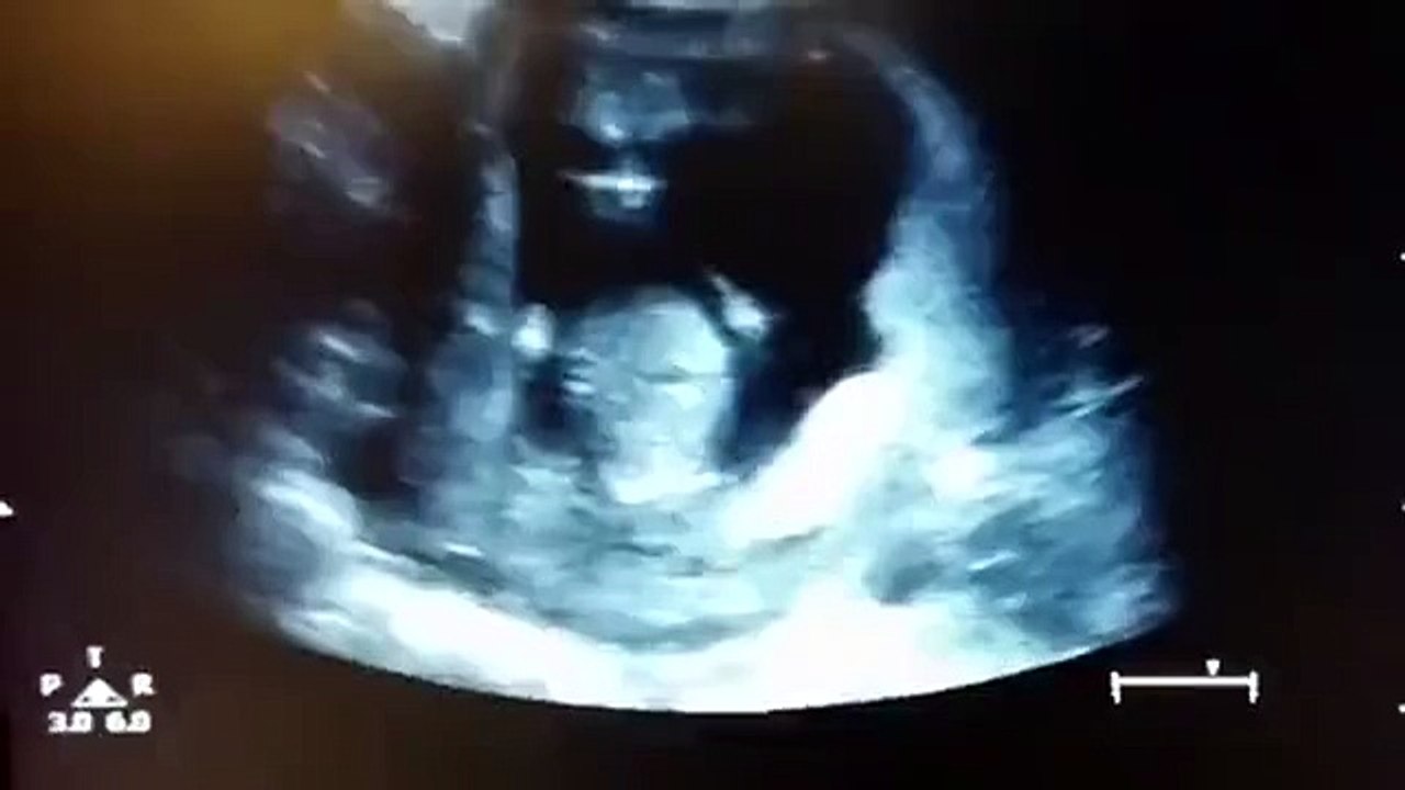 جنين يصفق داخل رحم أمه