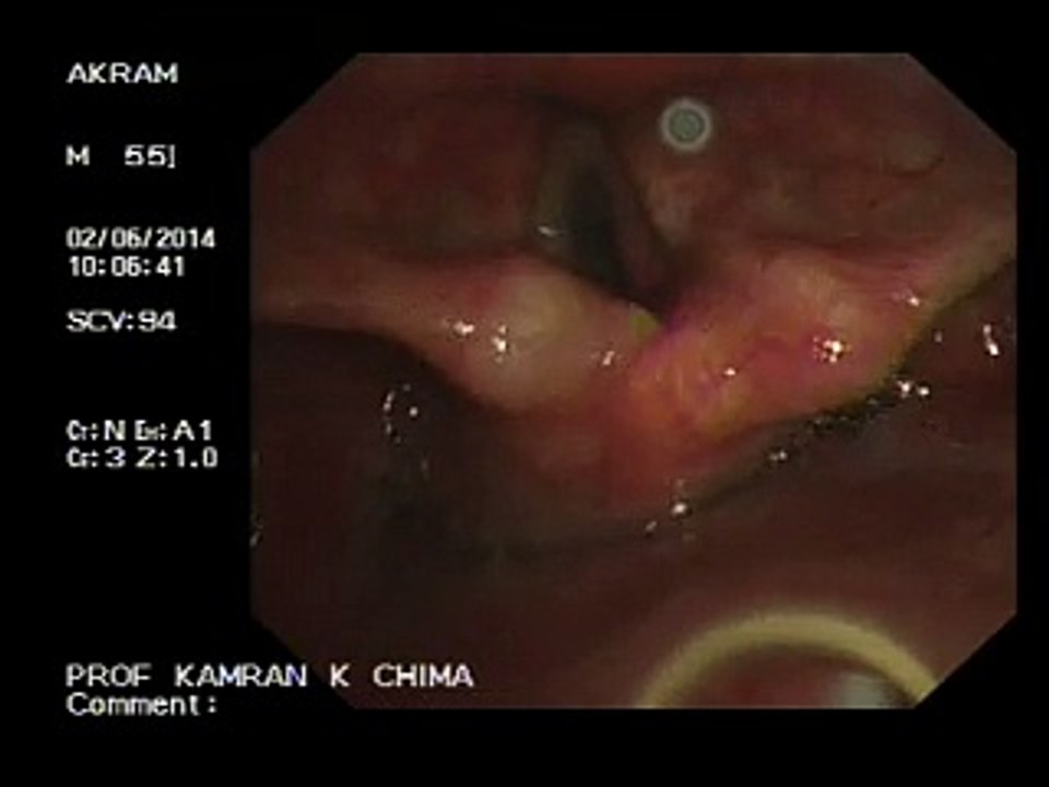 broncoscopy video akram