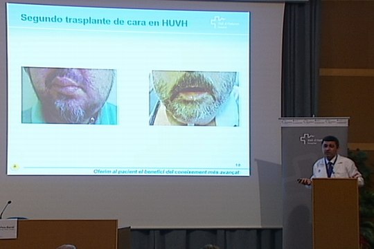 El Vall d'Hebron realiza un trasplante de cara