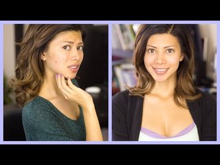 First Impression: Manuka Honey on Acne