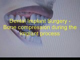 Dental implants procedure video(anim) using bone compression