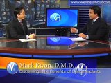 Dental Implants with Dr. Mark Kwon - Dental Implants