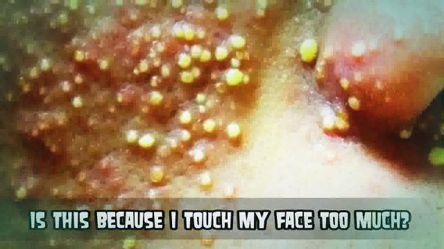 Tonights Pimples Zits, Pimples, Acne, Pores, Comedones, Popping Midnight Special