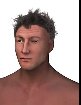 Botoks ile Kırışıklık Tedavisi-İzmir