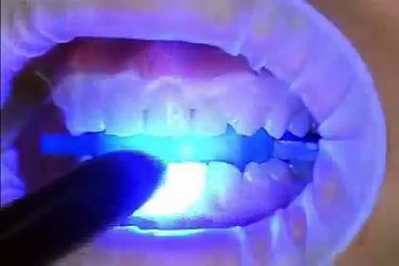 Diş Beyazlatma-Bleaching Tedavisi-Ankara