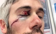touché par un patin au visage, Drew Miller frôle le drame