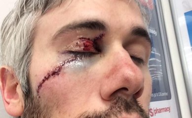 touché par un patin au visage, Drew Miller frôle le drame