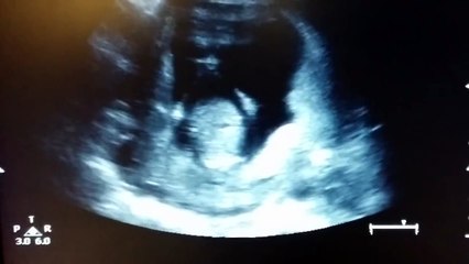 Echographie d'un bébé qui applaudit