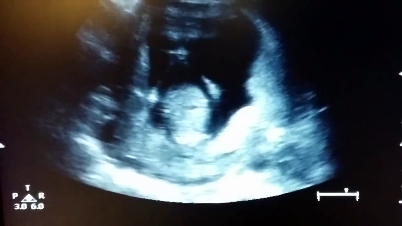 Echographie d'un bébé qui applaudit