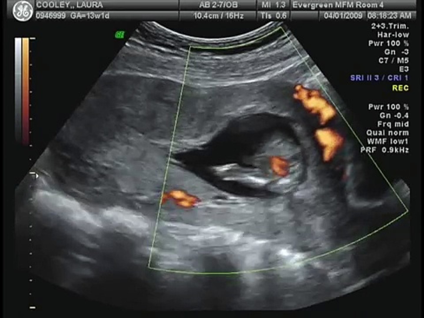 Ultrasound at 13 weeks gender