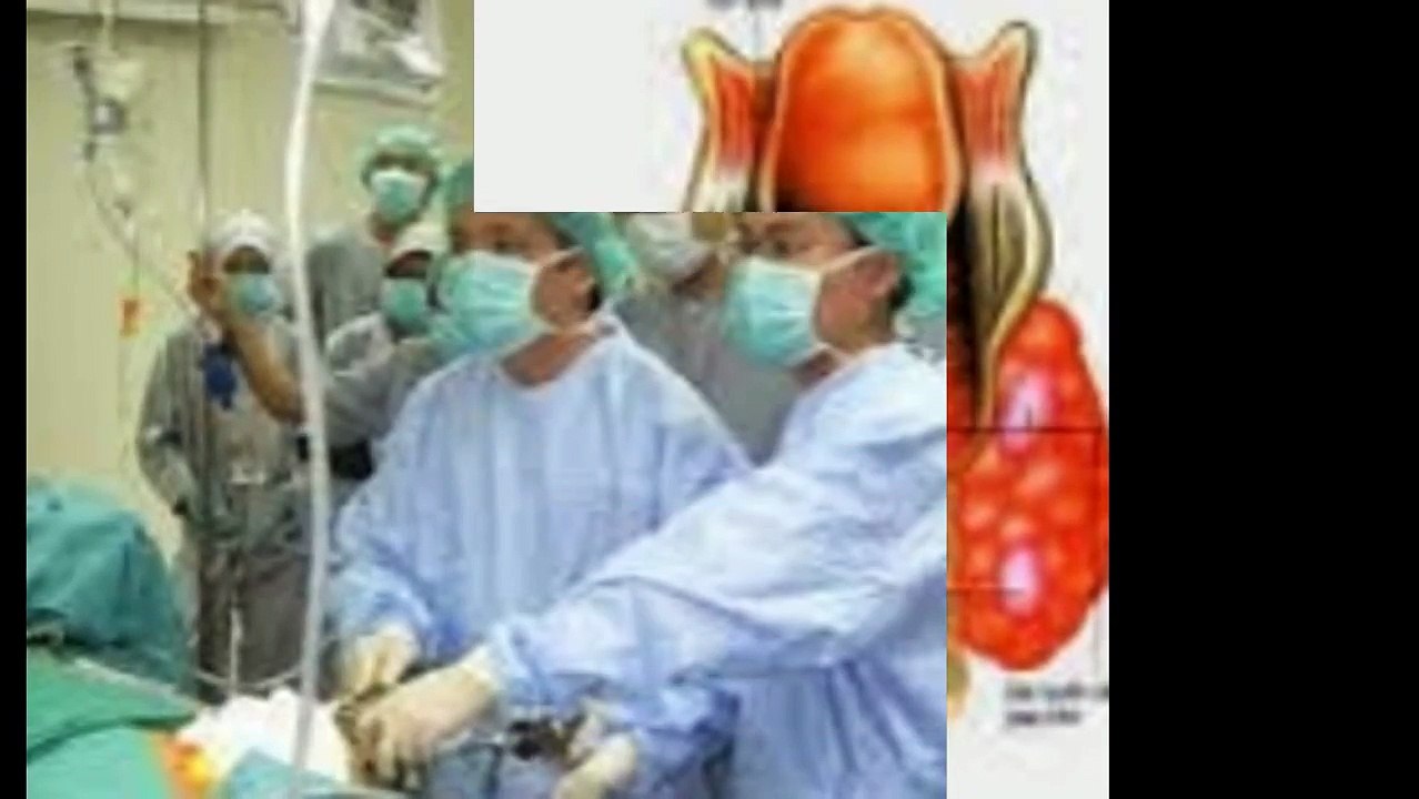 Ung thu tuyen giap dieu tri trieu chung nguyen nhan chan doan benh