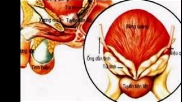 Ung thu tuyen tien liet dieu tri trieu chung nguyen nhan chan doan benh