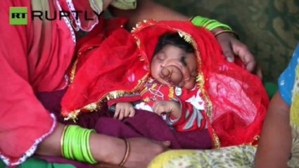 Fil Burunlu Doğan Bebek Tanrı Olarak Saygı Görüyor