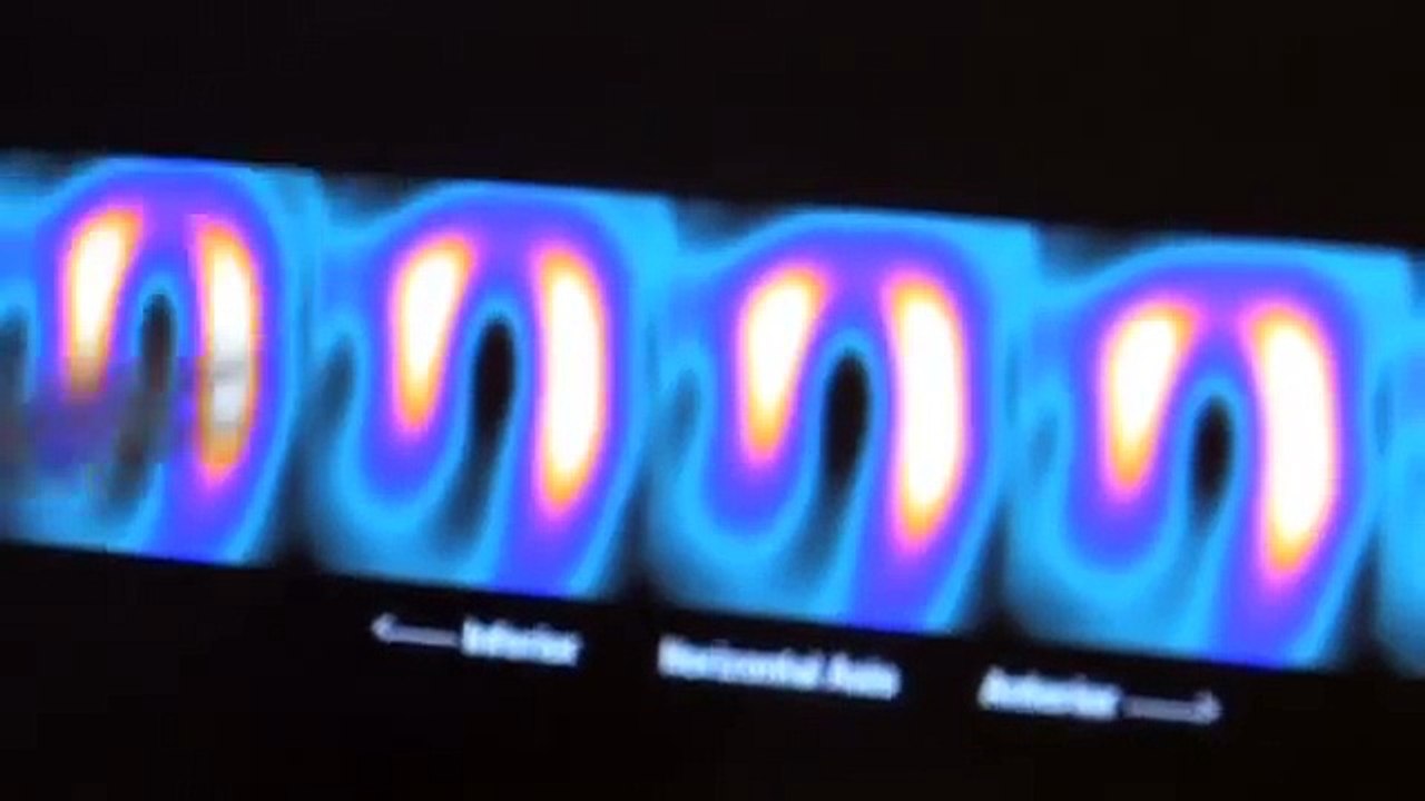 Imagerie médicale et médecine nucléaire : Tout savoir sur la scintigraphie cardiaque