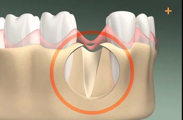 Zahnimplantation in 3D - Dental Implant 3D animation