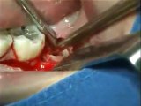 extraction wisdom tooth impacted (www.oralcamera.net)