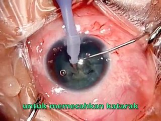 Pembedahan Katarak atau Selaput Mata