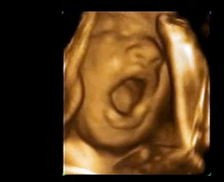 3D Ultrasound 30 weeks Yawning baby A New Conception 3D