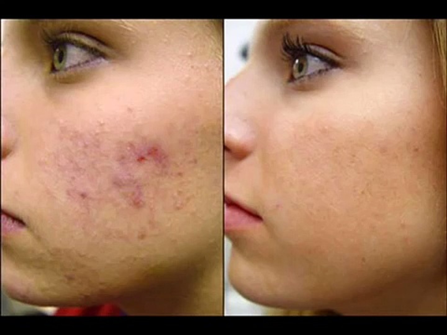 Eliminar manchas de la cara (borrar las manchas de la cara) Cómo eliminar  manchas de la cara - video Dailymotion