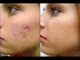 Eliminar manchas de la cara (borrar las manchas de la cara) Cómo eliminar manchas de la cara