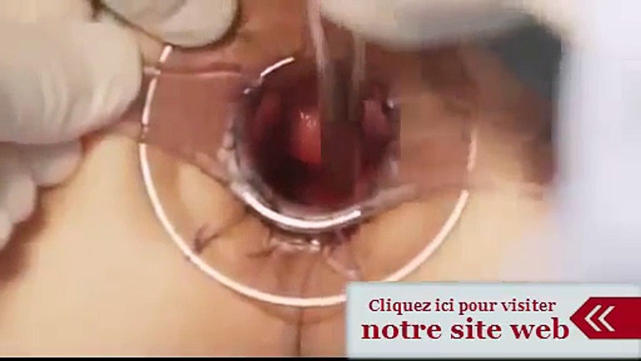 L’hémorroïdopexie par agrafage circulaire - Intervention de Longo HD
