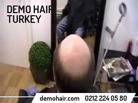 erkek protez saç fiyatları