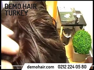 erkek protez saç yorumları