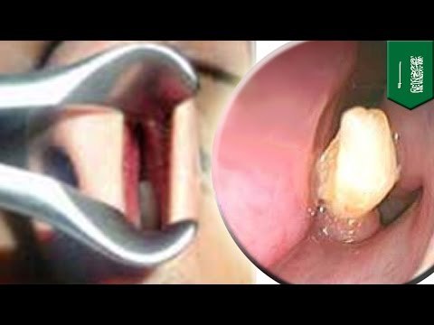 У жителя Саудовской Аравии в носу вырос зуб