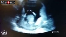 Anne karnında alkış tuttu, ultrasonda çekildi