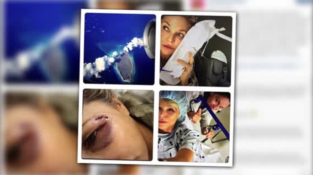 Christie Brinkley Injured After Altercation With a Bird