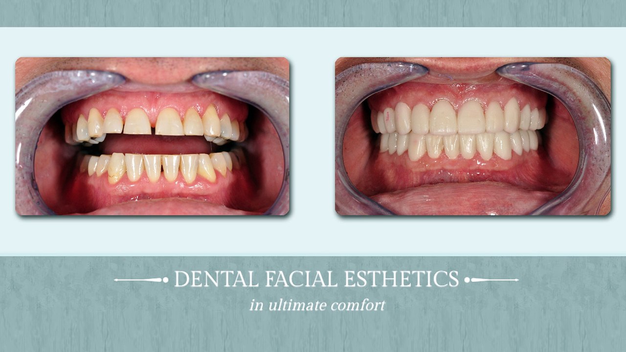 Dental Veneers - Stuart, FL - Palm City, FL - Port St. Lucie, FL