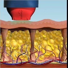 Selülit Tedavisi - Antalya