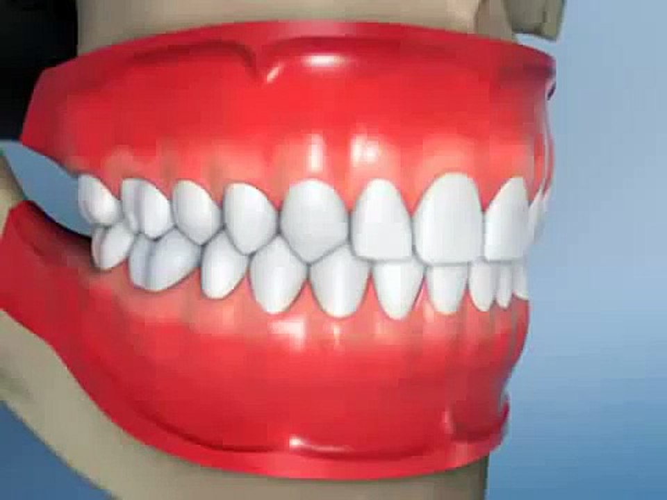 Diş Dolgusu Nasıl Yapılır?