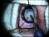 Canine cataract surgery with a lens implant in a dog