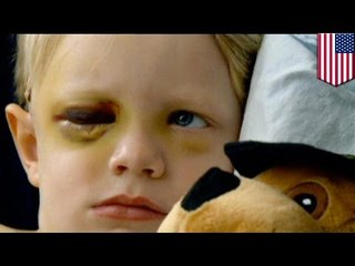 4-jähriger überlebt Baseball-Schlag an Kopf
