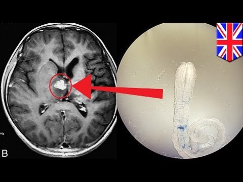 Ленточный червь четыре года жил в мозге британца