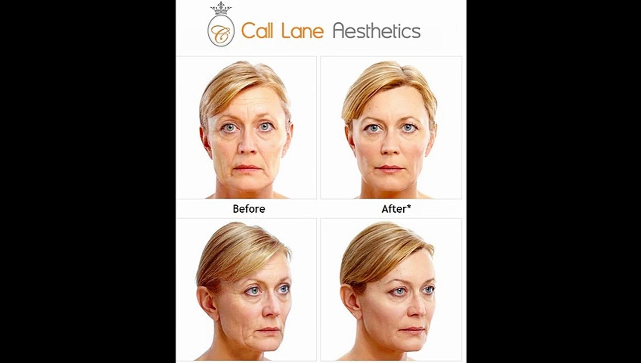Dermal Fillers  - www.claesthetics.com