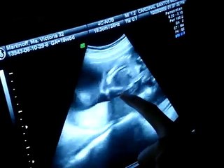 Surprise Twin Boys 20 week Ultrasound Scan