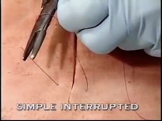 surgery simple interrupted suturing  wound