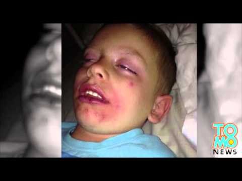 QUOI DE NEUF DOC?: Un garçon âgé de 5 ans perd 99% de peau