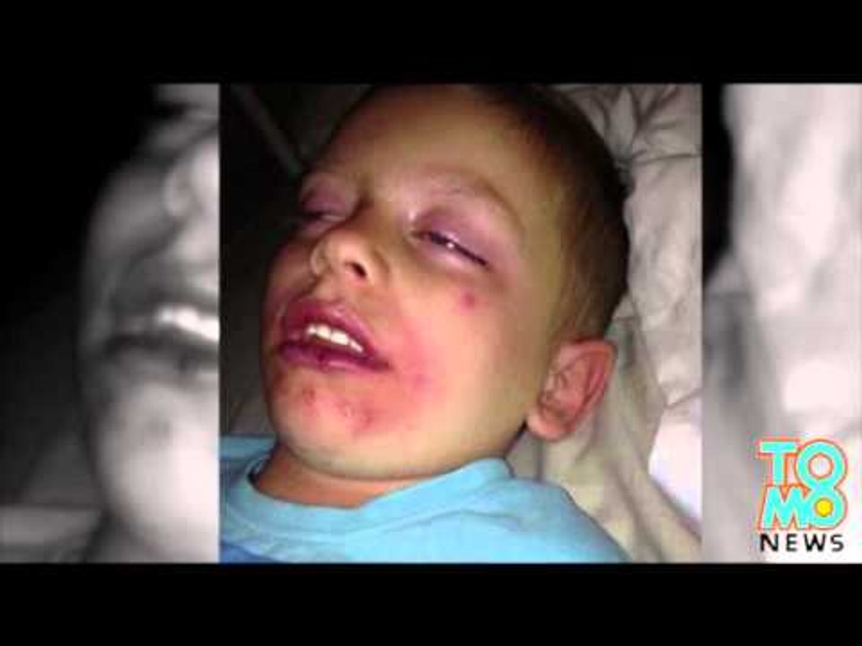 QUOI DE NEUF DOC?: Un garçon âgé de 5 ans perd 99% de peau