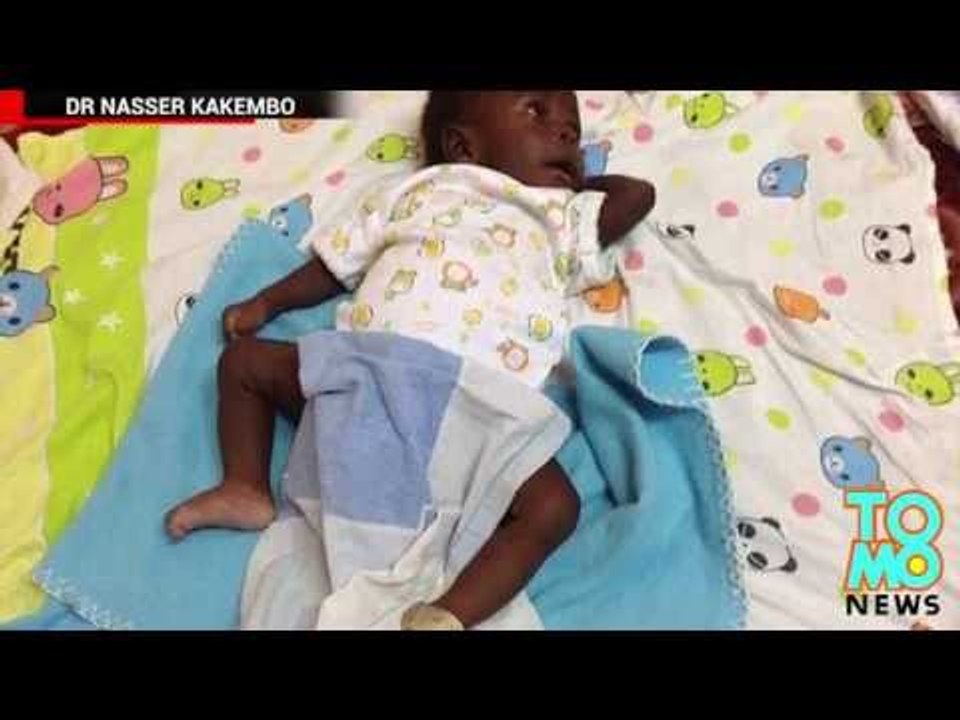 QUOI DE NEUF DOC?: Un bébé de quatre mois se fait enlever son jumeau parasite.