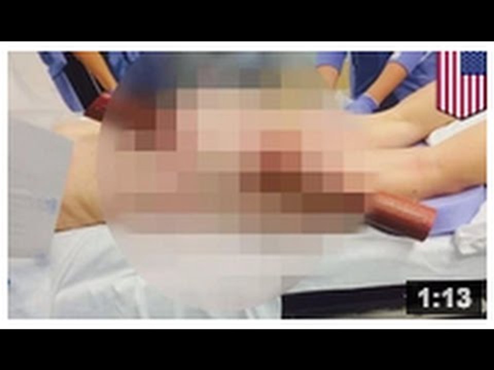 ACCIDENT EN TEXTANT: Une femme se fait transpercer les fesses par un poteau.