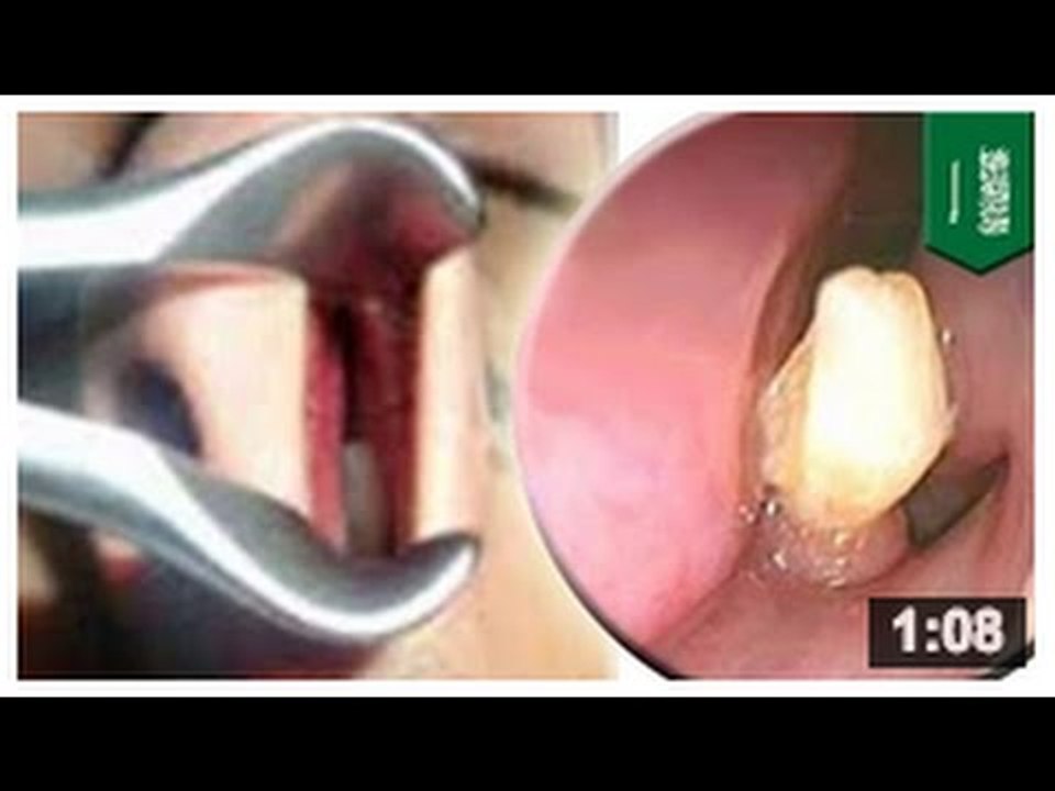 QUOI DE NEUF DOC: Un homme se fait arracher une dent de son nez! et alors… oh lo lo lo les gens…